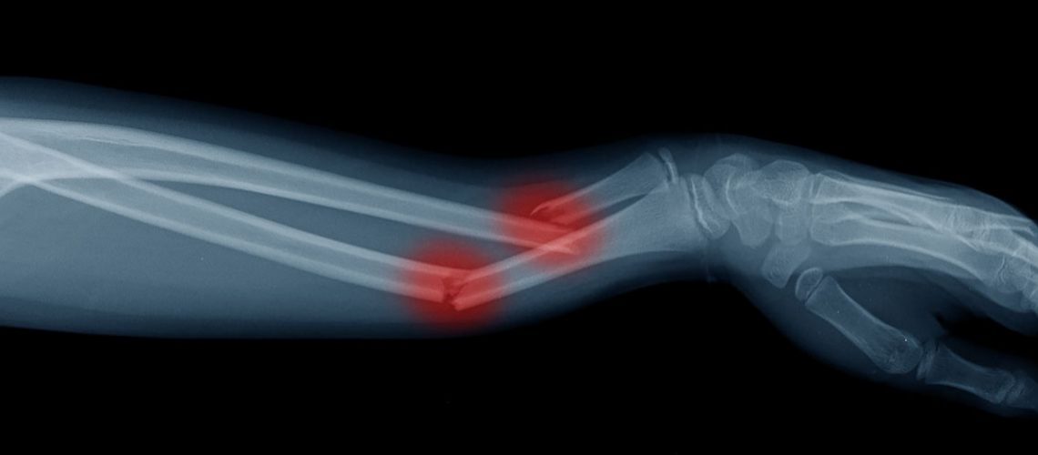 Reinforcing Men Broken Arm Side View